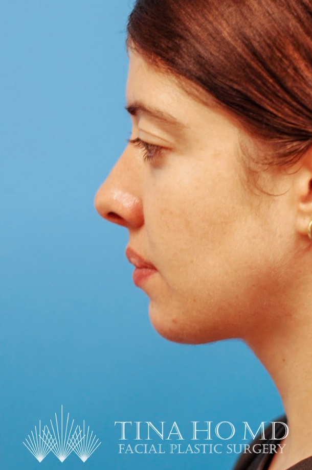 Patient's face after jawline contouring procedure
