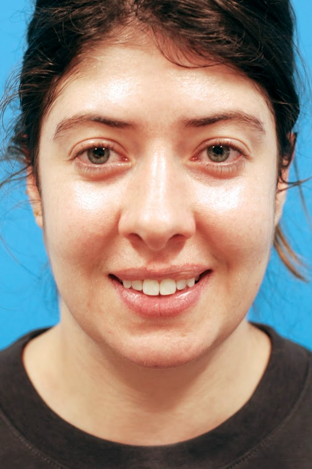 Patient's face before jawline contouring procedure