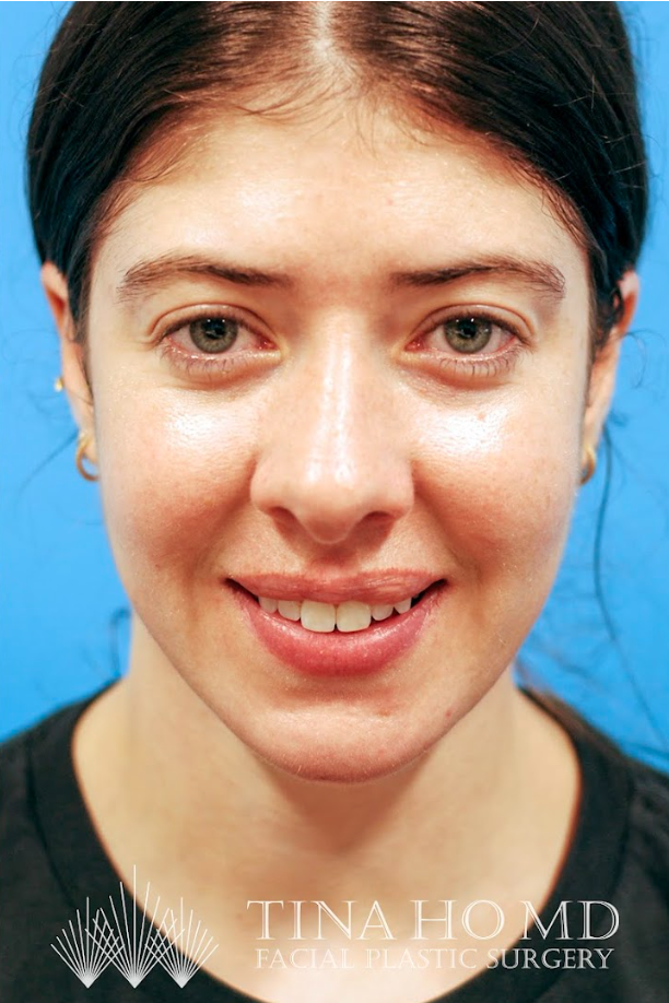 Patient's face after jawline contouring procedure
