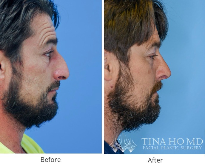 Rhinoplasty