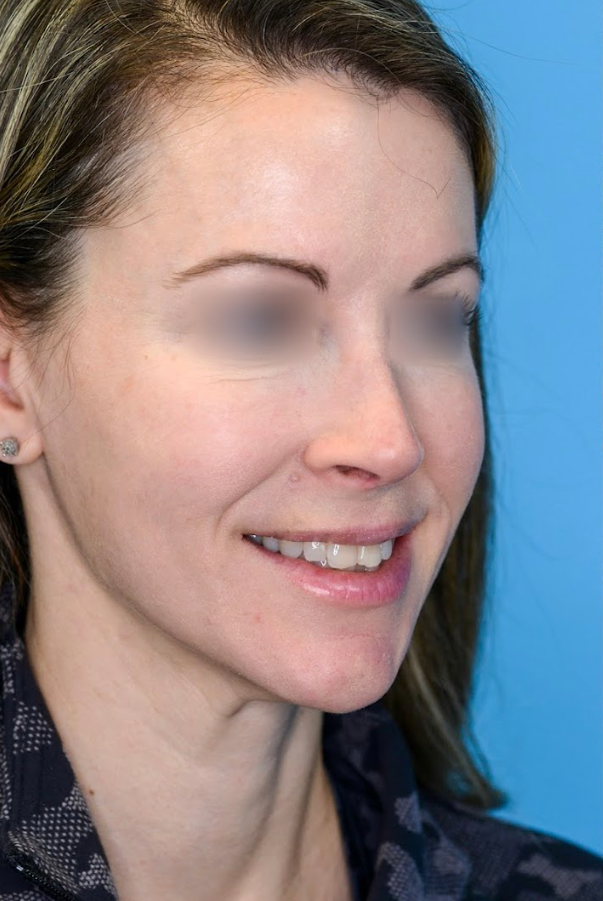 Close-up of patient's lips before lip augmentation surgery