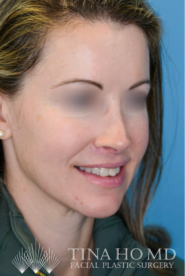 Close-up of patient's lips after lip augmentation surgery