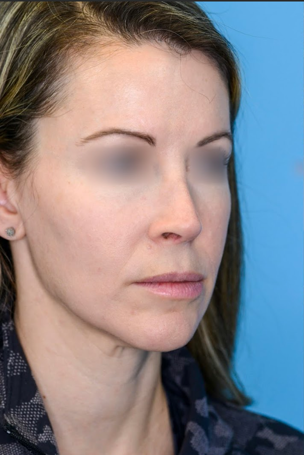 Close-up of patient's lips before lip lift procedure