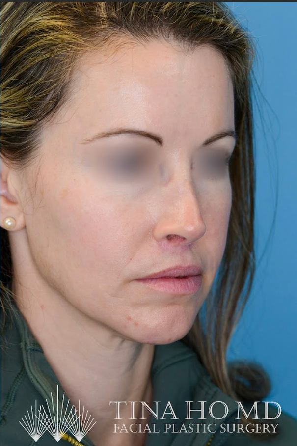 Close-up of patient's lips after lip lift procedure
