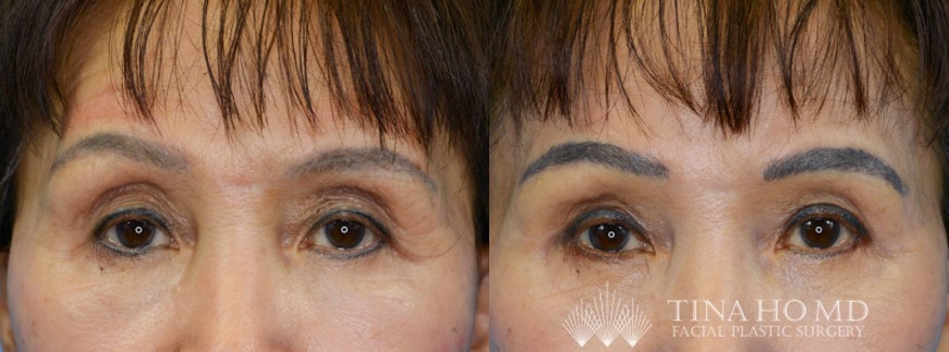 Browlift