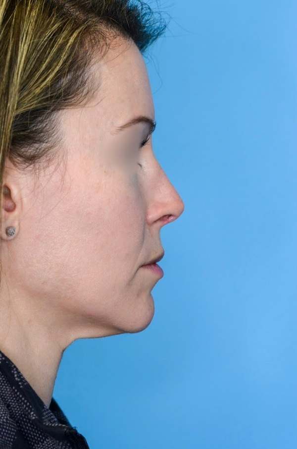 Close-up of patient's lips before lip augmentation results