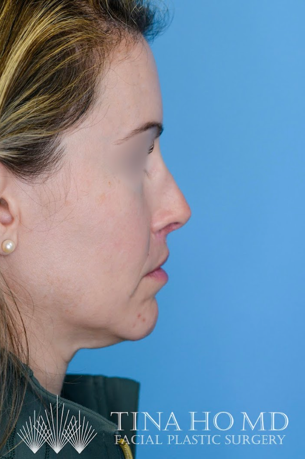 Close-up of patient's lips after lip augmentation results