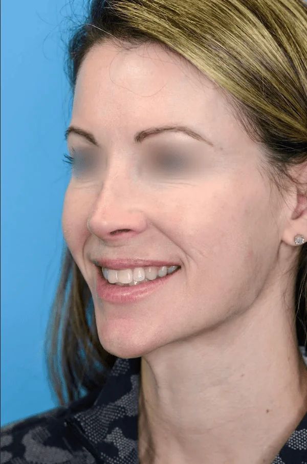 Close-up of patient's lips before lip enhancement treatment