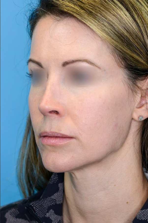 Close-up of patient's lips before lip augmentation results