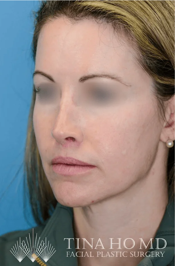 Close-up of patient's lips after lip augmentation results