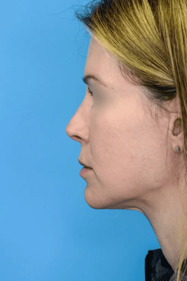 Close-up of patient's lips before lip enhancement surgery