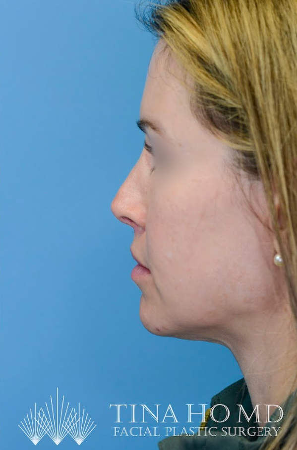 Close-up of patient's lips after lip enhancement surgery