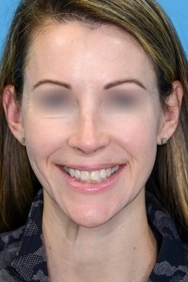 Close-up of patient's lips before lip augmentation procedure