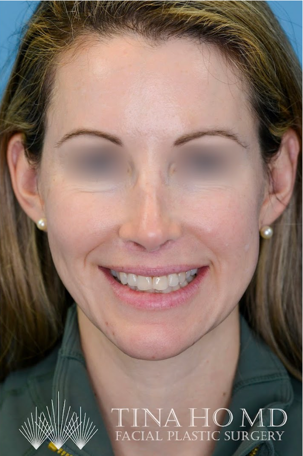 Close-up of patient's lips after lip augmentation procedure