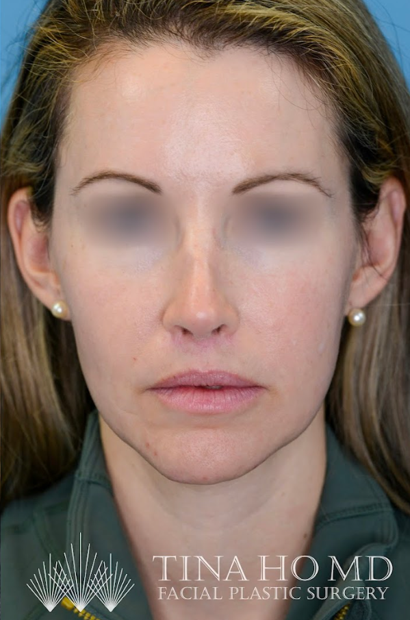Close-up of patient's lips after lip augmentation treatment