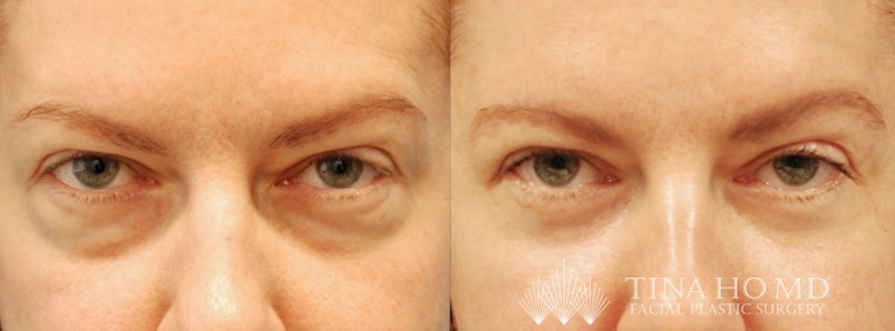 lower eyelid surgery before and after - frontal view