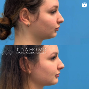 Injectables facial contouring