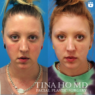 lip surgery patient