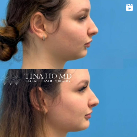 Facial_Contouring_IG_02
