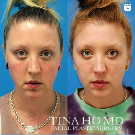 Facial_Contouring_IG_02