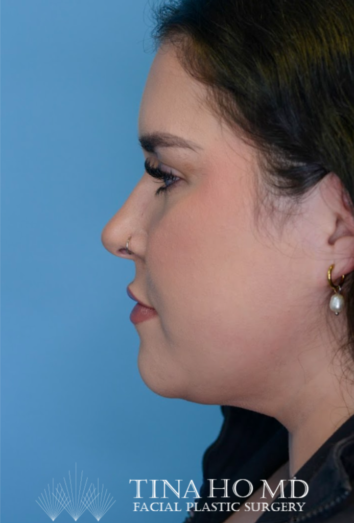 Patient's face after chin and neck liposuction