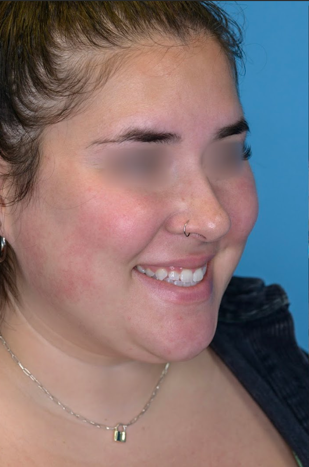 Patient's face before chin and neck liposuction