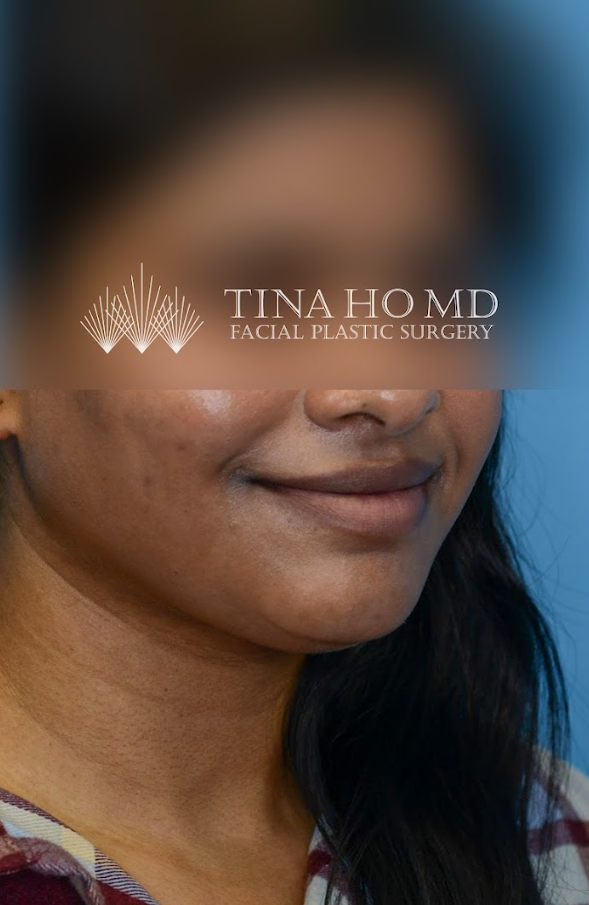 Close-up of patient's lips after lip augmentation surgery