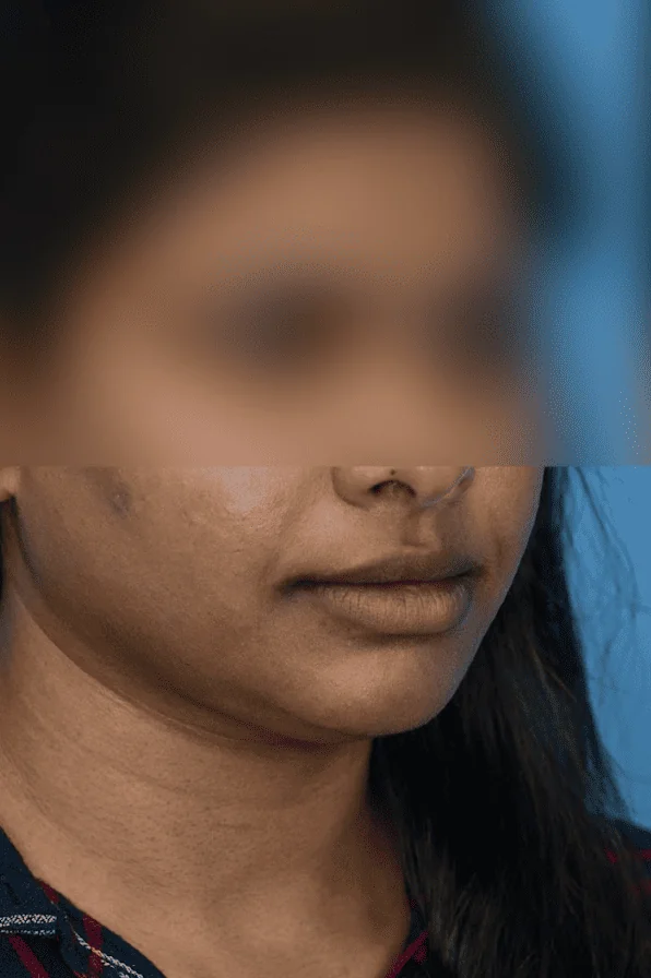 Close-up of patient's lips before lip lift procedure