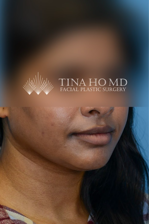 Close-up of patient's lips after lip lift procedure