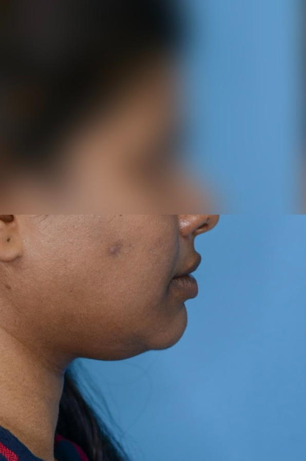 Close-up of patient's lips before lip augmentation results