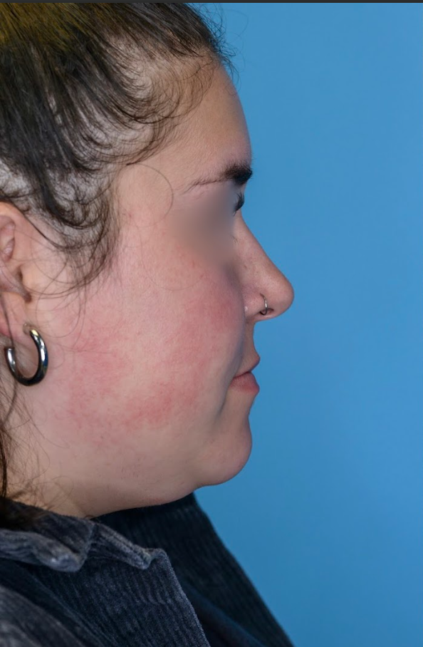 Patient's face before chin and neck liposuction