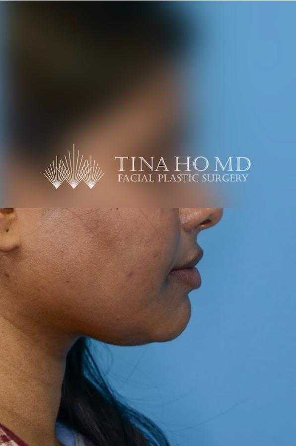 Close-up of patient's lips after lip augmentation results