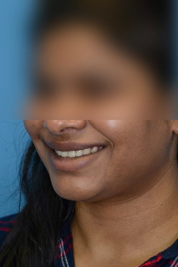 Close-up of patient's lips before lip enhancement treatment