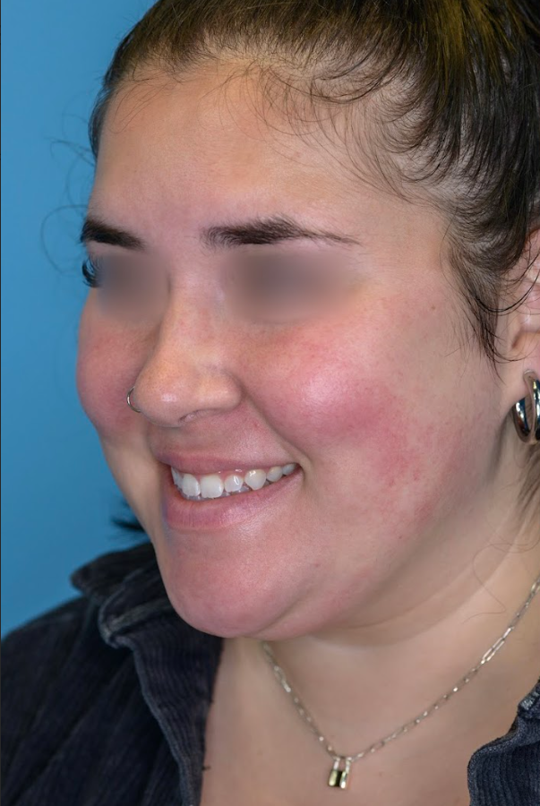 Patient's face before chin and neck liposuction