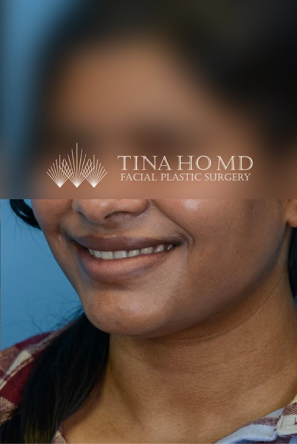 Close-up of patient's lips after lip enhancement treatment