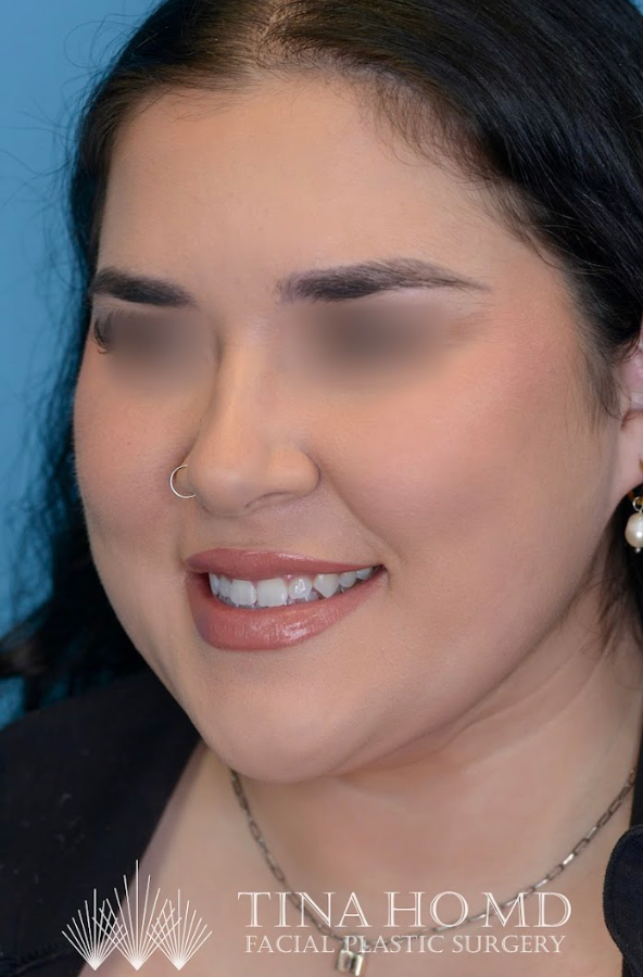 Patient's face after chin and neck liposuction