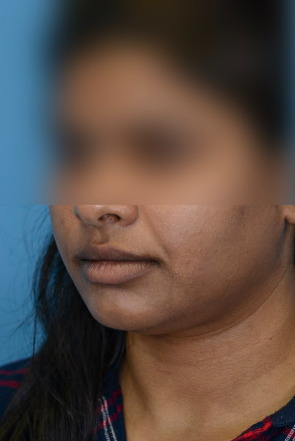 Close-up of patient's lips before lip augmentation results