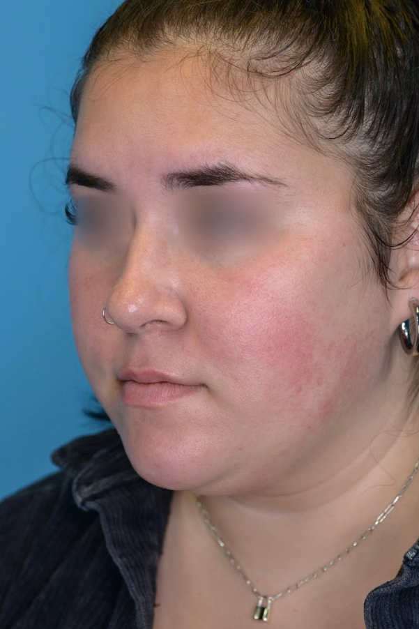 Patient's face before chin and neck liposuction