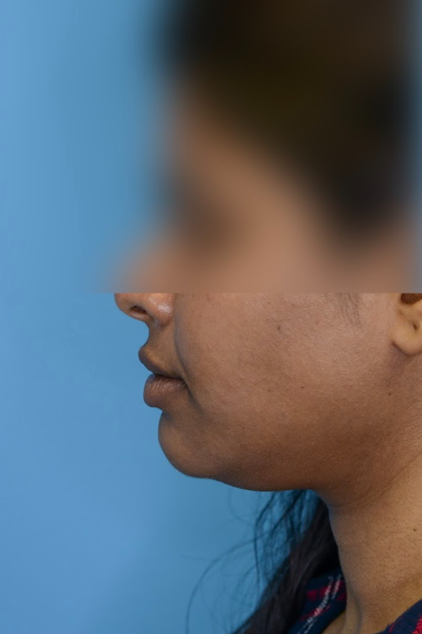 Close-up of patient's lips before lip enhancement surgery