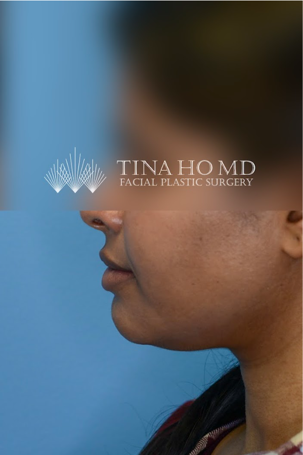 Close-up of patient's lips after lip enhancement surgery