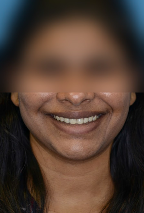 Close-up of patient's lips before lip augmentation procedure