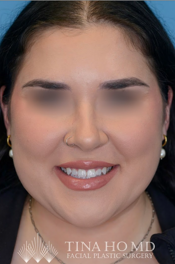 Patient's face after chin and neck liposuction