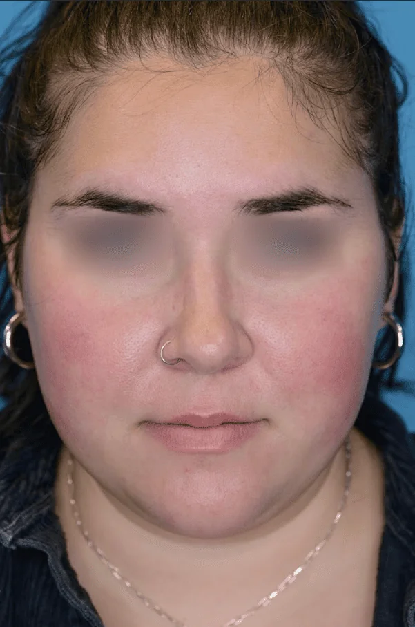 Patient's face before chin and neck liposuction