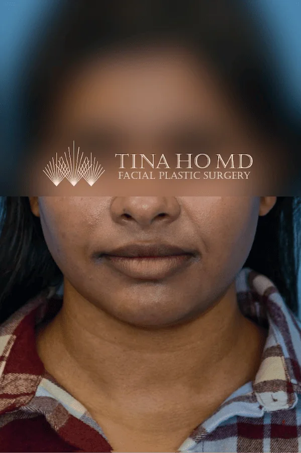 Close-up of patient's lips after lip augmentation treatment