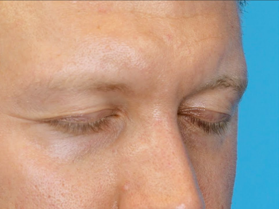 SZ oblique before