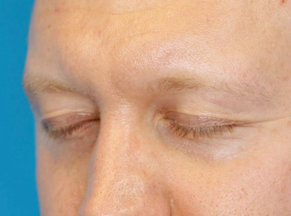 SZ oblique before