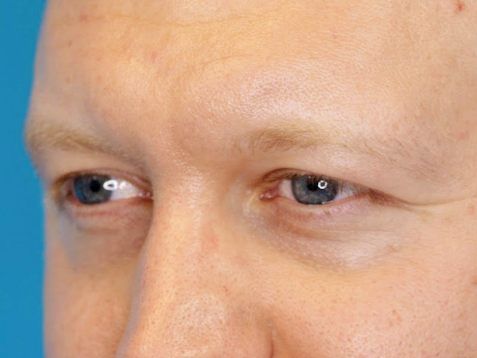 SZ oblique before
