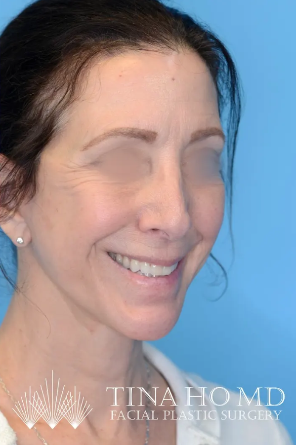 ML after oblique