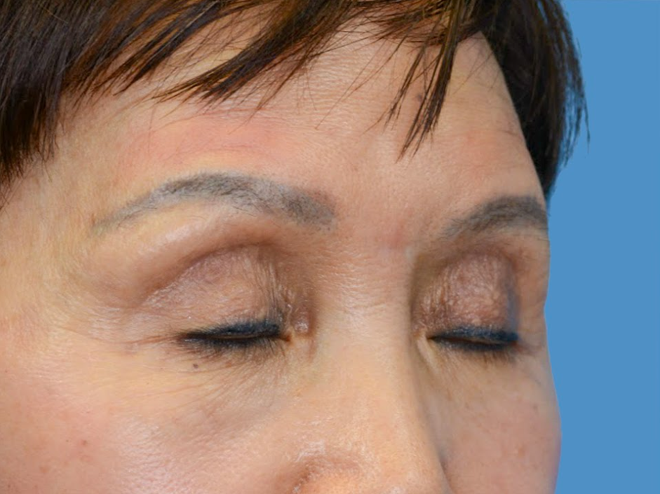 Patient's face before a Philadelphia brow lift