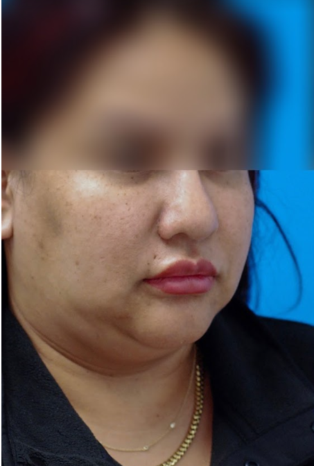 Patient's profile view before chin augmentation for improved contour